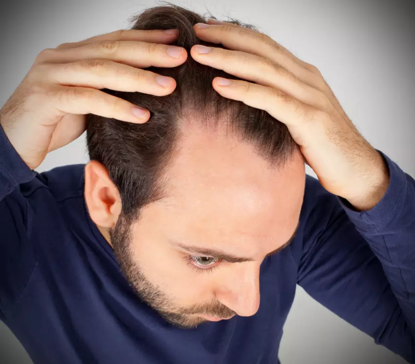 signes of balding at 20
