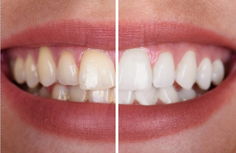 What are the causes of yellow teeth