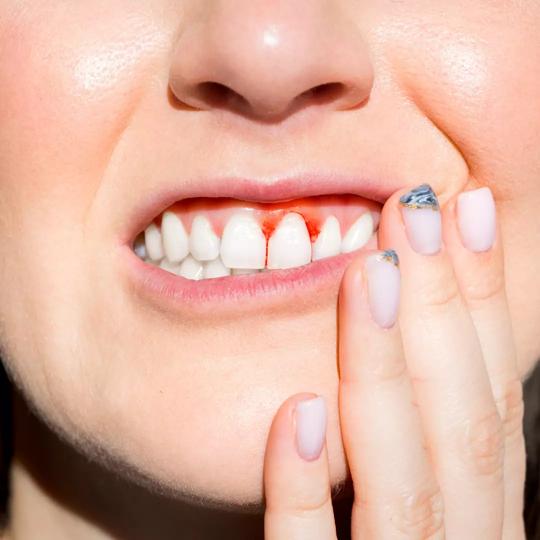 How to cure gum disease without a dentist