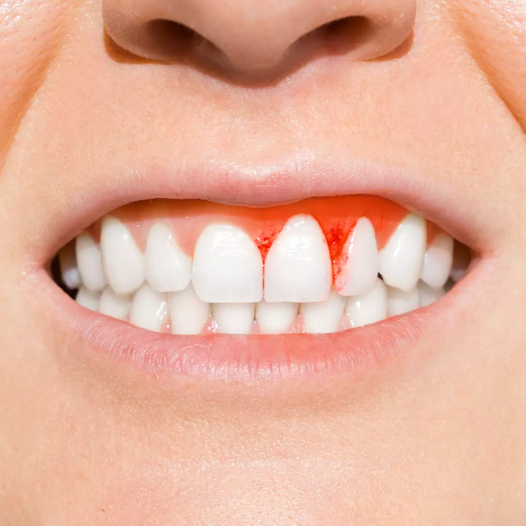 how to stop bleeding gums naturally