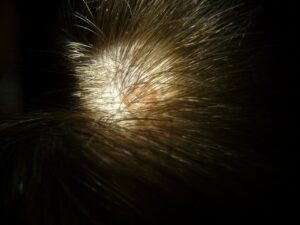scalp, liver spot, head